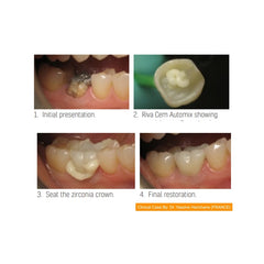 RIVA CEM AUTOMIX- Resin Modified Glass Ionomer Luting Cement with Superior Bond & High Strength.