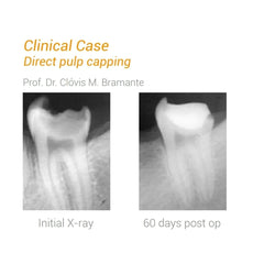 Angelus MTA - Bioceramic Reparative Cement