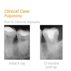 Angelus MTA - Bioceramic Reparative Cement