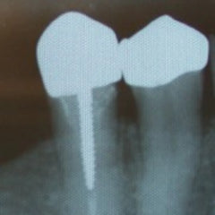 Angelus Reforpost Metallic - Intraradicular Posts