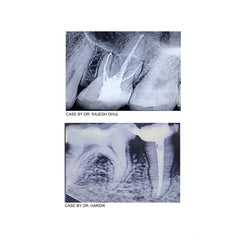 Avue A+ Premixed - Premixed Calcium Hydroxide based Root Canal Sealer
