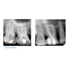 AVUE Aurum S cross section files- Gold Heat Treated Files in S cross-section.