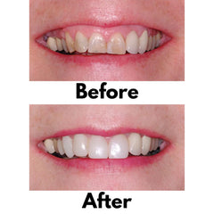 Bioclear 360° Veneer Matrices - Significantly Stiffer Matrices for Composite Veneers