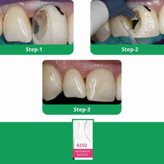 Bioclear Anterior Mini Kit - Modern Matrix System for Esthetic Restorations