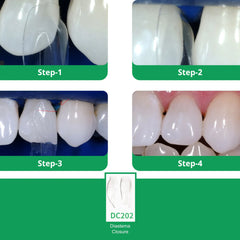 Bioclear Anterior Matrix – Diastema Closure Series