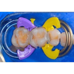 Bioclear TwinRing - For Class II Matrix Adaptation
