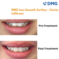 DMG Icon Smooth Surface - Caries Infiltrant