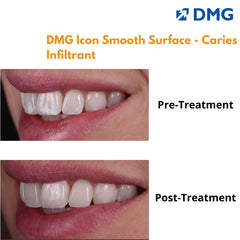 DMG Icon Smooth Surface - Caries Infiltrant