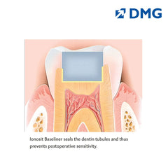 DMG Ionosit - Light Cured Baseliner Material