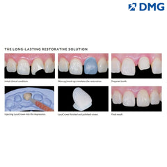 DMG Luxacrown - Semi-Permanent Chair Side Composite Crown