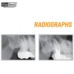 DiaDent DiaProseal - Epoxy Resin Based Root Canal Sealer