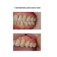 DiaFil Flow -Light cured flowable composite