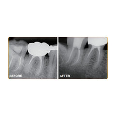 Dia-root bio sealer- Bioceramic Root Canal Sealing Material