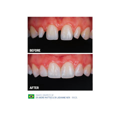 SDI Luna 2 - Nano Hybrid Universal Composite with Superior Strength & Aesthetics.