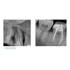 Avue Aurum Progressive Taper- Gold Heat-Treated Rotary Files with Progressive Taper