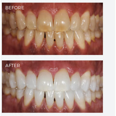 SDI Pola Office+ - Tooth Whitening System