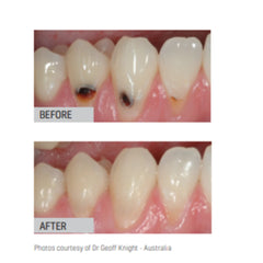 SDI Riva Light Cure - Resin Reinforced Glass Ionomer Cement