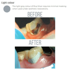 SDI Riva Silver - Silver Reinforced Glass Ionomer Cement