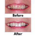 Bioclear 360°  Veneer Matrices - Significantly Stiffer Matrices for Composite Veneers