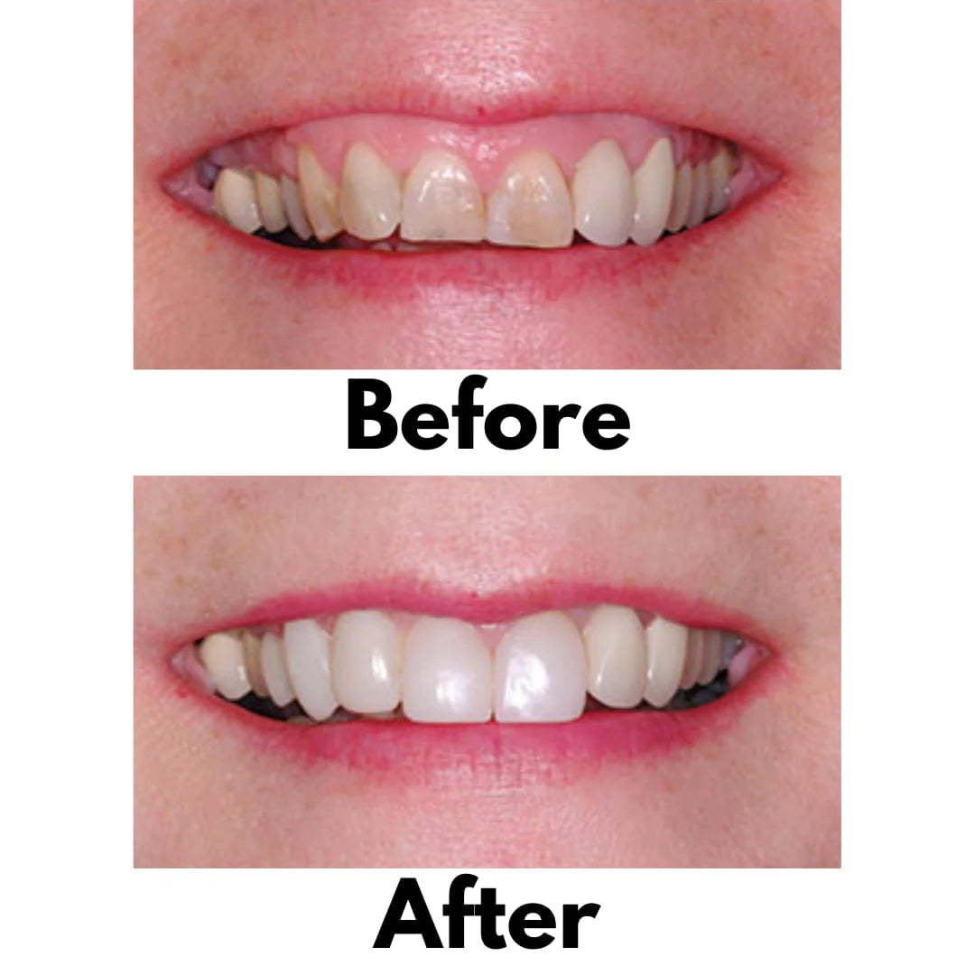 Bioclear 360°  Veneer Matrices - Significantly Stiffer Matrices for Composite Veneers