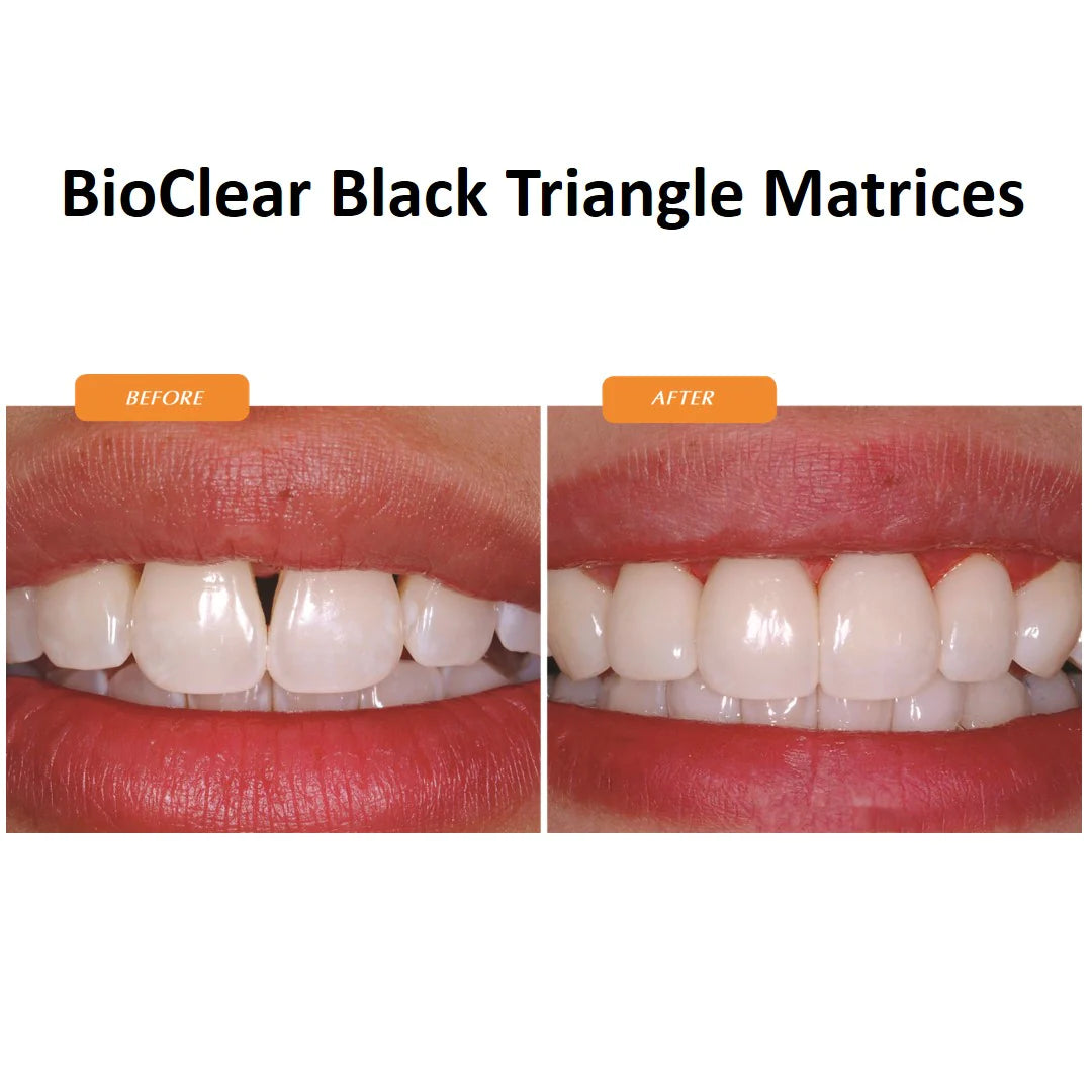 Bioclear Black Triangle Matrices - Refill Packs-Matrices for Anterior ...