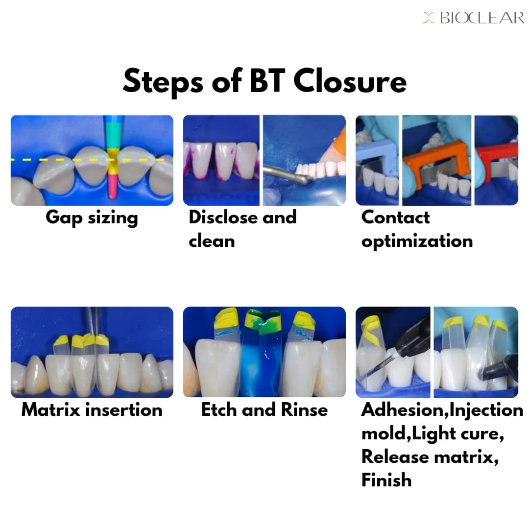 Bioclear Black Triangle Matrices - Refill Packs-Matrices for Anterior Esthetic Restorations