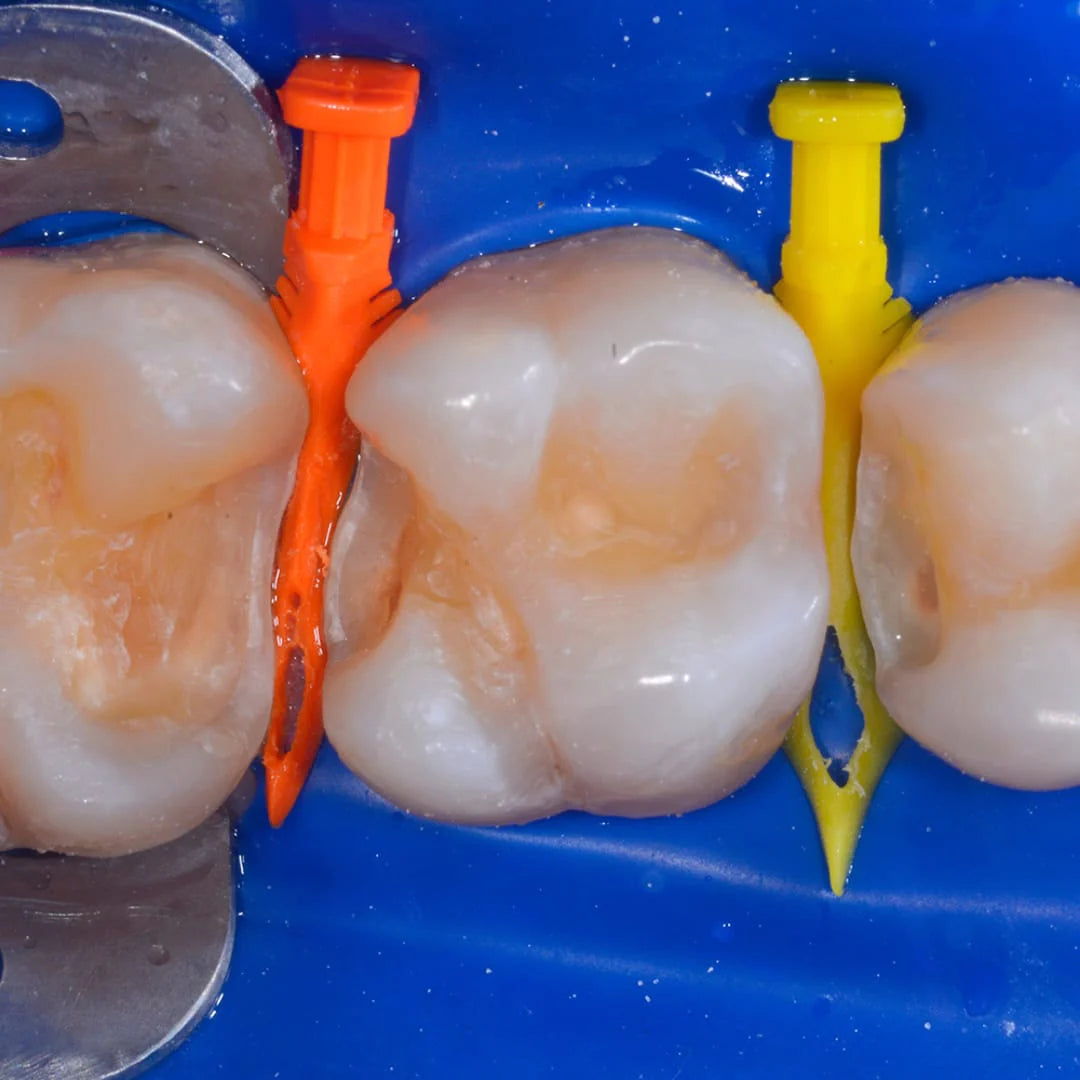 Bioclear Diamond Wedges Refill/Kit - Wedges to be Used Along with Bioclear Matrix system