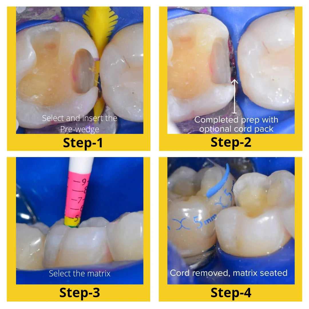 Bioclear Evolve Matrices Mini Kit - Anatomically Pre-Shaped Posterior Matrices