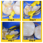 Bioclear Evolve Matrices Mini Kit - Anatomically Pre-Shaped Posterior Matrices