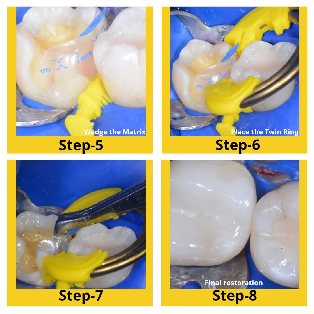 Bioclear Evolve Matrices Mini Kit - Anatomically Pre-Shaped Posterior Matrices