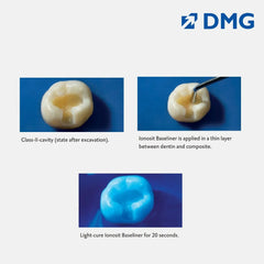 DMG Ionosit - Light Cured Baseliner Material