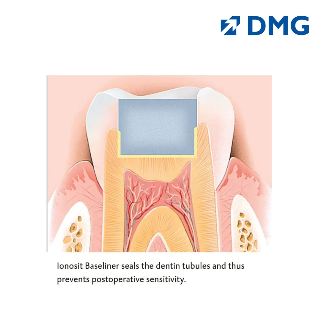 DMG Ionosit - Light Cured Baseliner Material