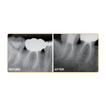 Dia-root bio sealer- Bioceramic Root Canal Sealing Material