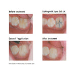 SDI Conseal F - Fluoride Releasing Pit & Fissure Sealant