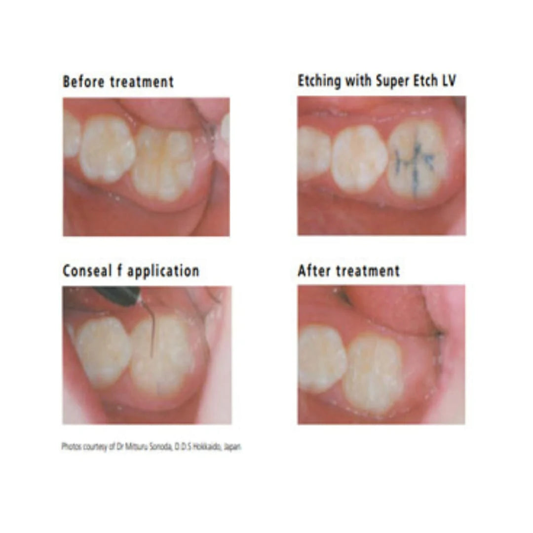 SDI Conseal F - Fluoride Releasing Pit & Fissure Sealant
