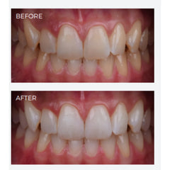 SDI Pola Office - Tooth Whitening System