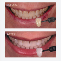 SDI Pola Rapid - Tooth Whitening System