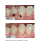 SDI Riva Light Cure - Resin Reinforced Glass Ionomer Cement