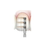 Avue True Diamond Burs- DC Series- Tri Wheel Depth Cutters